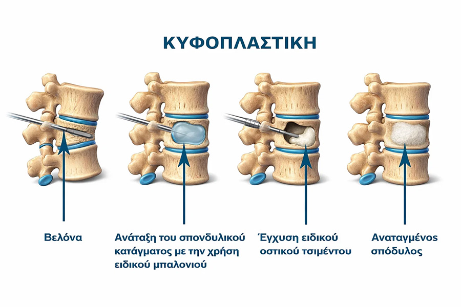 νευροχειρουργός σπονδυλικής στήλης Αθήνα